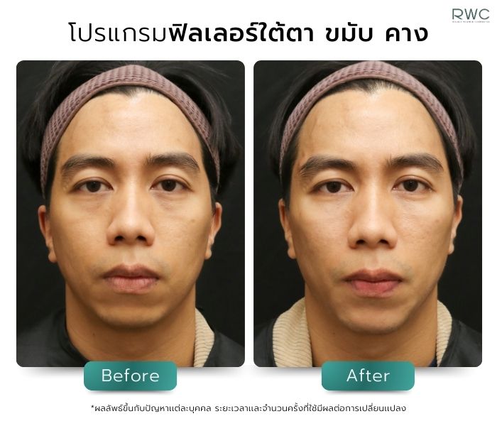 รีวิวโปรแกรมฟิลเลอร์ใต้ตา ขมับ คาง โดยแพทย์ผู้เชี่ยวชาญของหมอขนม หมอบี