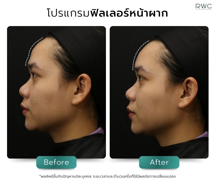 รีวิวโปรแกรมฟิลเลอร์หน้าผากโดยแพทย์ผู้เชี่ยวชาญ หมอบี