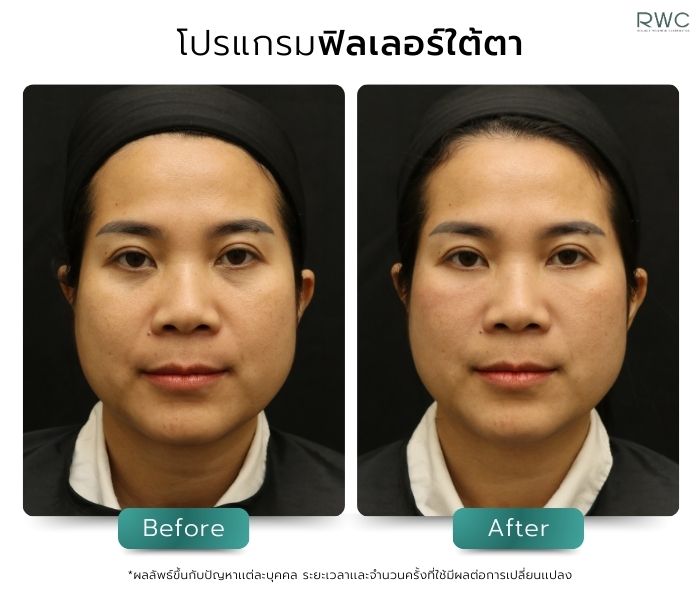 รีวิวหลังฉีดฟิลเลอร์ใต้ตา ที่ RWC Clinic โดยแพทย์ผู้เชี่ยวชาญ