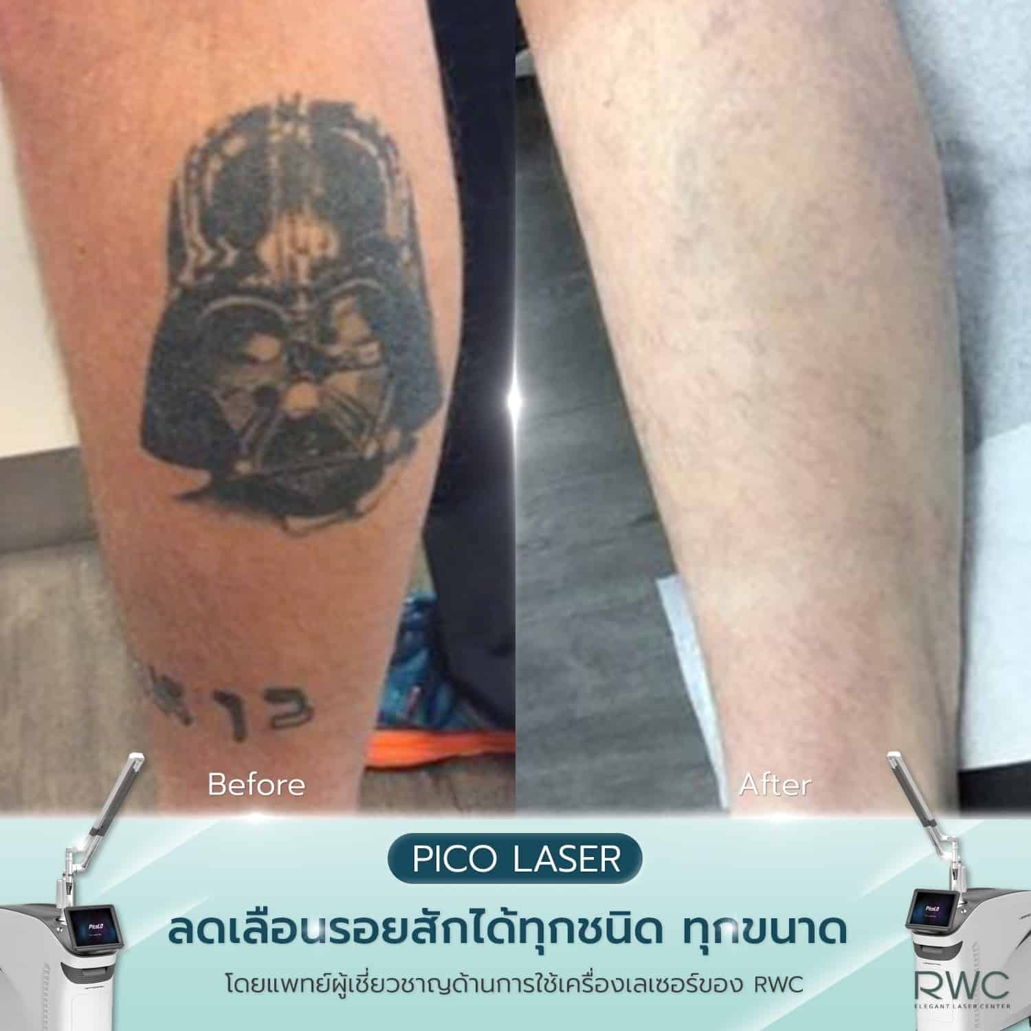 rwcclinic reviews pico laser tattoo