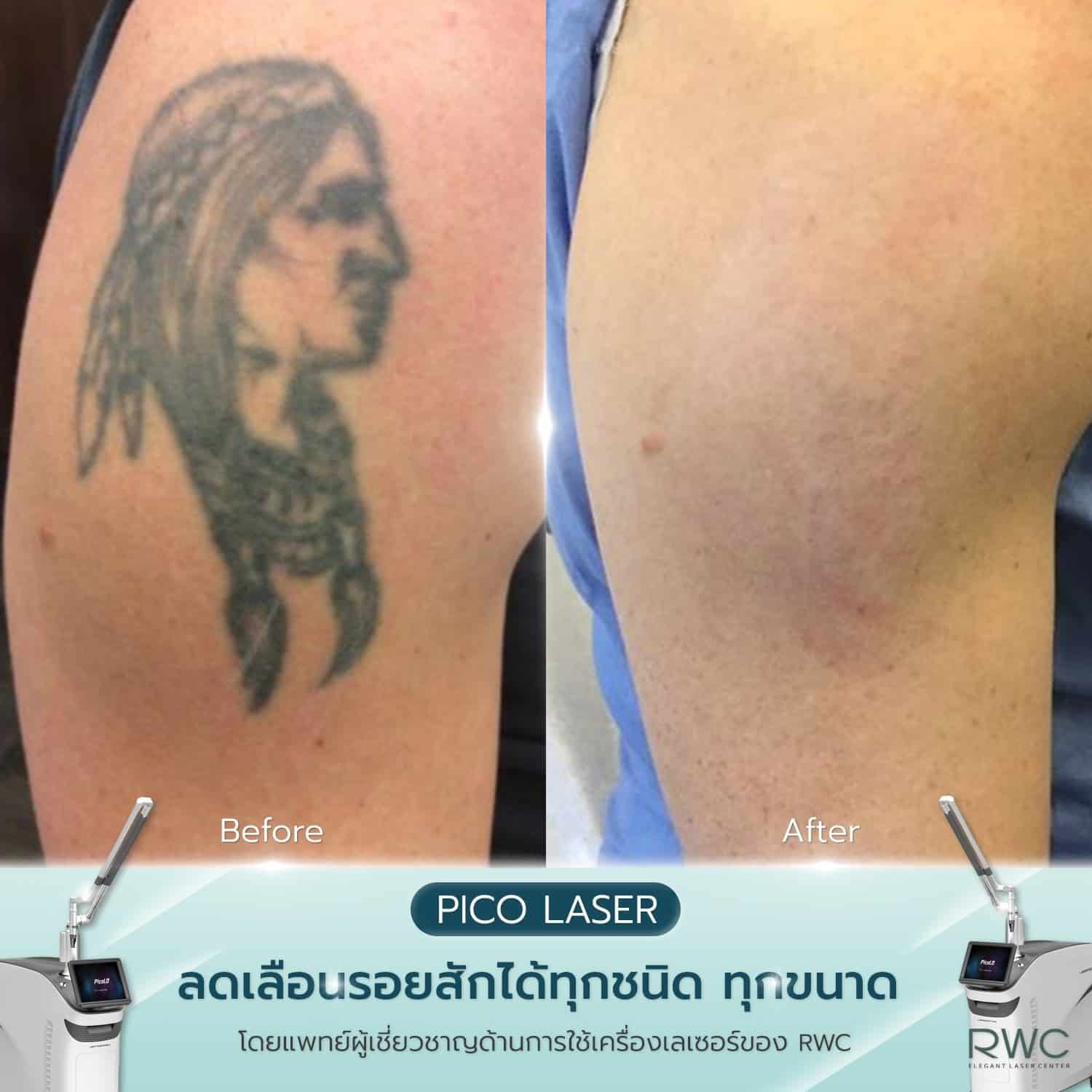 reviews tattoo by pico laser