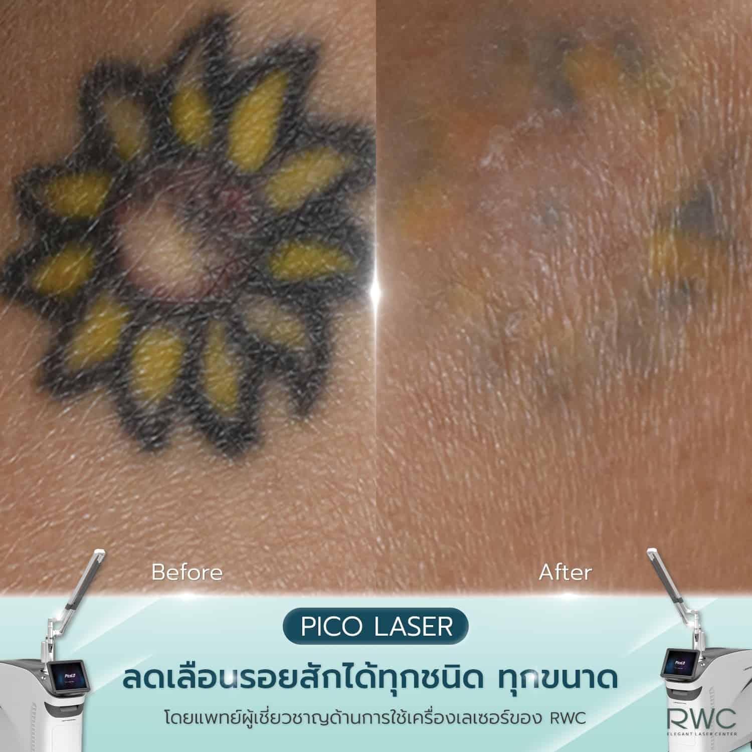 rwc reviews pico laser tattoo