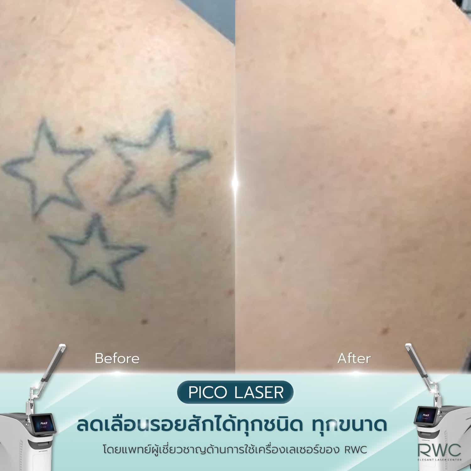 tattoo pico laser