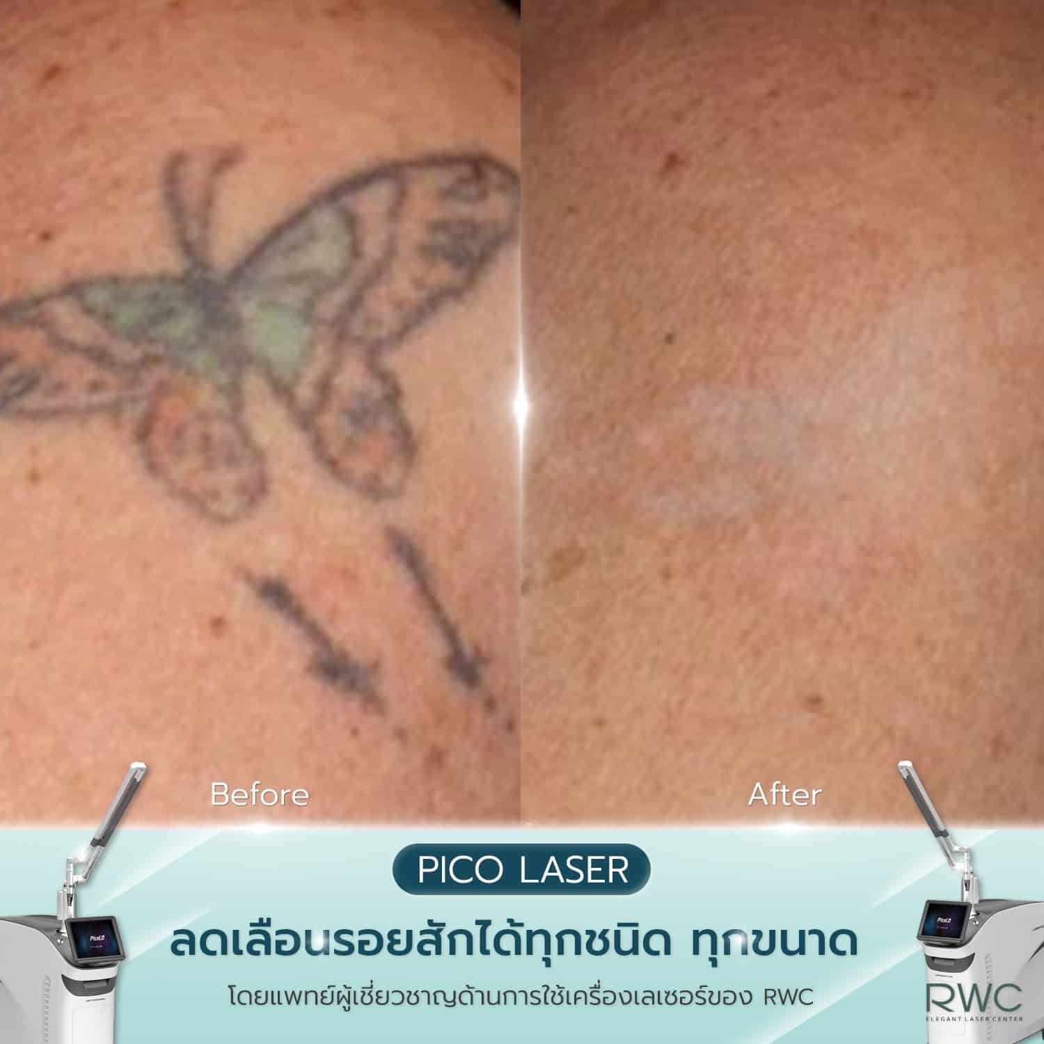 review pico laser tattoo