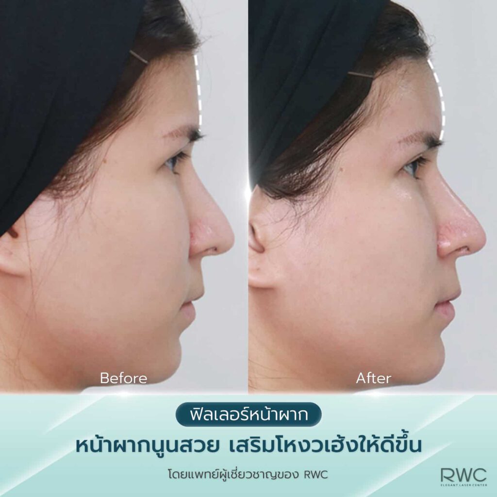 ฉีดฟิลเลอร์ ฟิลเลอร์หน้าผาก RWC - โปรโมชั่น